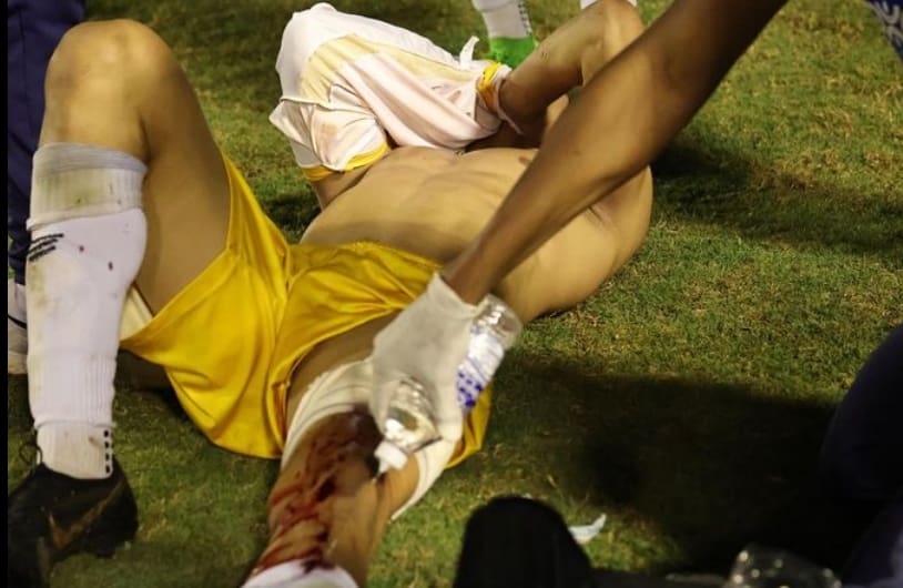 Um homem está deitado na grama, com uma perna dobrada e a outra estirada. Ele tampa o rosto. Sua coxa esquerda sangra, e a mão de outra pessoa tenta conter o sangramento.