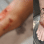 Imagem está dividida em duas. A primeira está focada em três feridas próximas ao calcanhar de uma criança, já sem sangramento. A segunda mostra o pé inteiro, com uma ferida central maior, com sangramento. As duas imagens estão desfocadas.