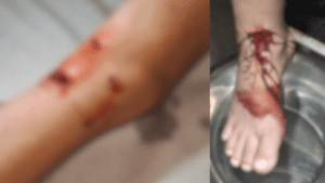 Imagem está dividida em duas. A primeira está focada em três feridas próximas ao calcanhar de uma criança, já sem sangramento. A segunda mostra o pé inteiro, com uma ferida central maior, com sangramento. As duas imagens estão desfocadas.