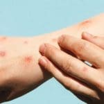 Alguém coça os braços, que estão com bolhas vermelhas por causa da monkeypox.