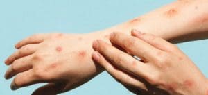 Alguém coça os braços, que estão com bolhas vermelhas por causa da monkeypox.