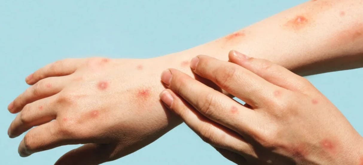 Alguém coça os braços, que estão com bolhas vermelhas por causa da monkeypox.