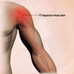 Imagem Braço inflamado imagem ilustrativa