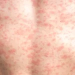 Imagem costas com sarampo