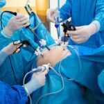 Imagem Cirurgia Bariátrica, médicos segurando equipamentos cirurgicos