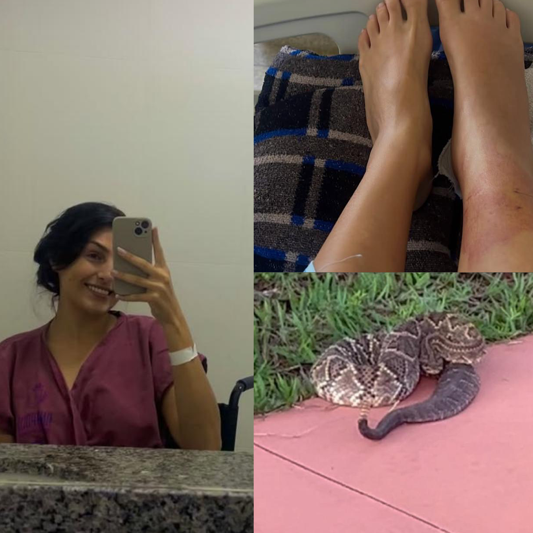 Imagem mulher, cobra e perna picada