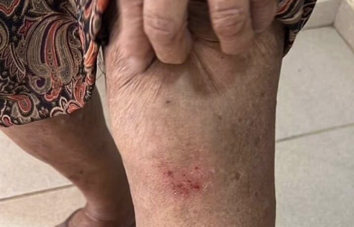 Imagem mulher mostrando a pena com hematoma e ferimento